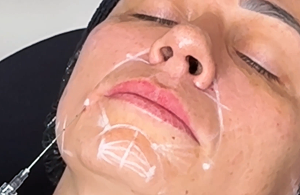 Aplicación de relleno facial femenino
