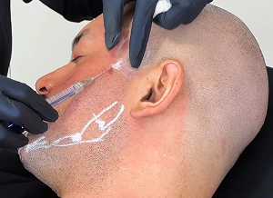 Aplicación de relleno facial masculino