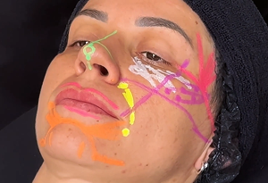 Marcación facial femenina para relleno