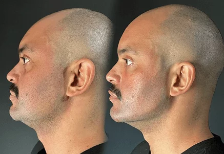 Resultado de tratamiento 4